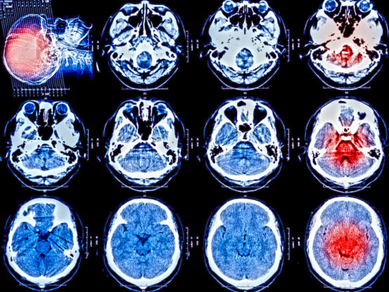 What are the long-term effects of a serious brain injury?